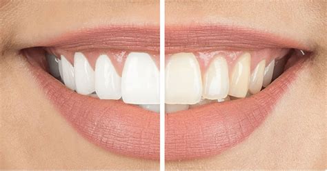 Achieve a Brighter Smile with the Power of Magic Natural Teeth Whitening